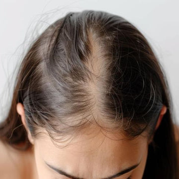 Perte de cheveux • Alopécie
