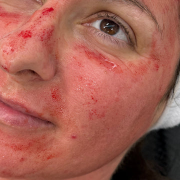 Microneedling PRP