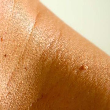 Retrait d'acrochordons