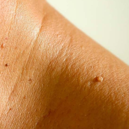 Retrait d'acrochordons